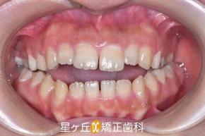 Before