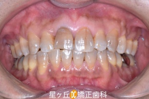 治療終了時