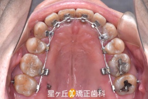 裏側矯正治療中