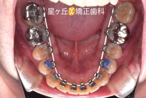 裏側矯正治療中
