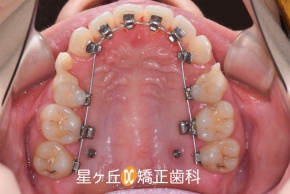 裏側矯正治療中
