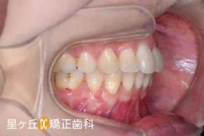 治療終了時