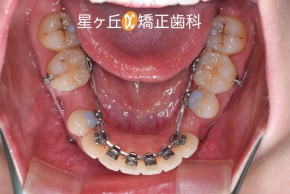 裏側矯正治療中