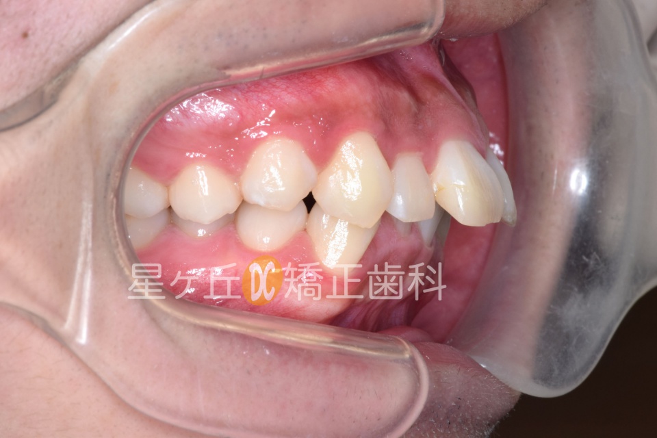 初診時 右側