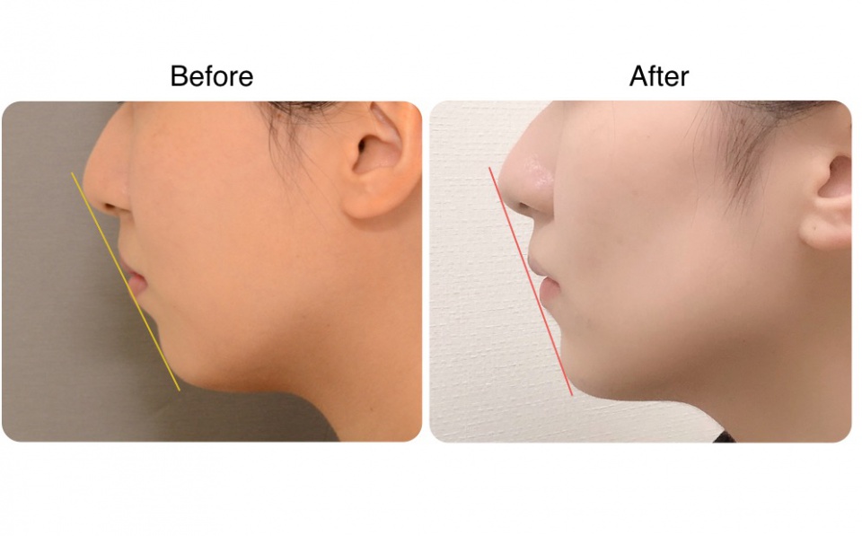 横顔の変化 スタッフブログ 名古屋で歯列矯正なら星ヶ丘駅１分の星ヶ丘矯正歯科