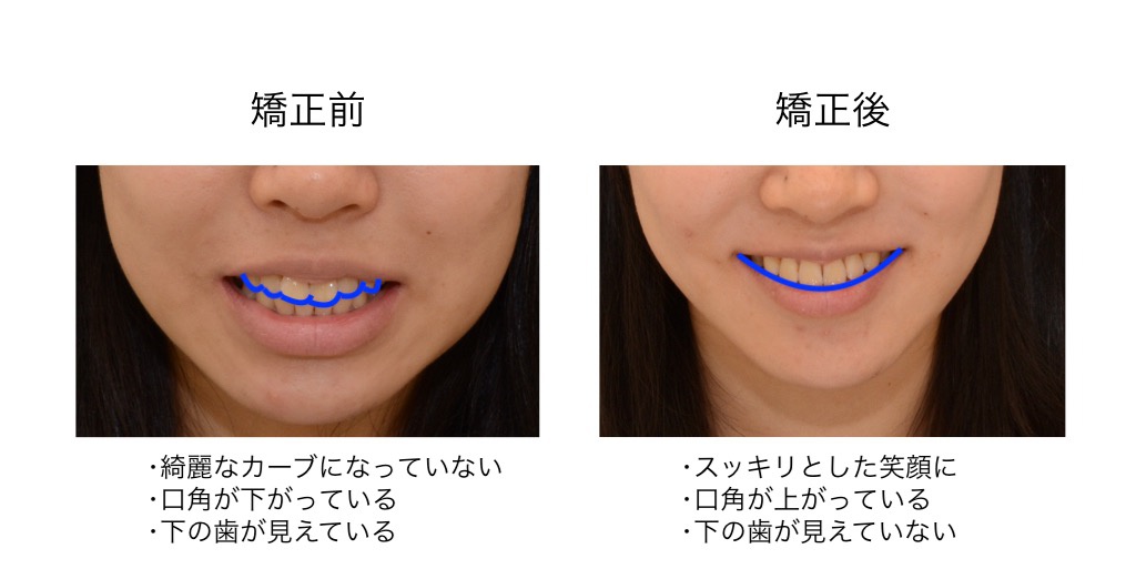 スマイルライン スタッフブログ 名古屋で歯列矯正なら星ヶ丘駅１分の星ヶ丘dc矯正歯科