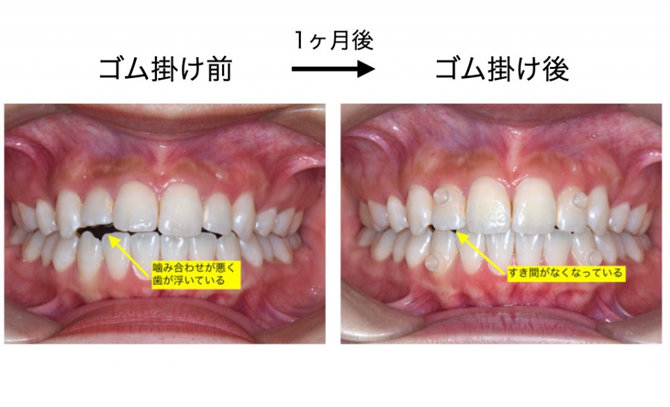 image:ゴム掛けによる歯並びの変化