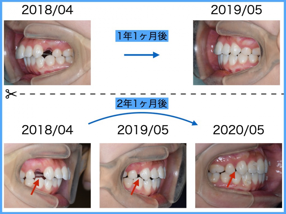 image:歯列矯正での抜歯のすき間