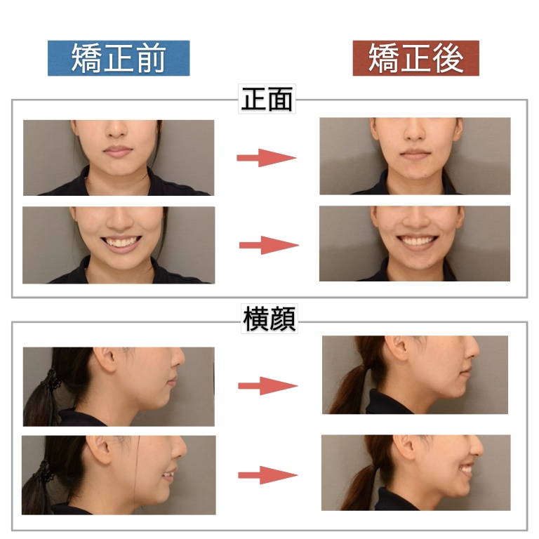 image:歯列矯正による顔の変化