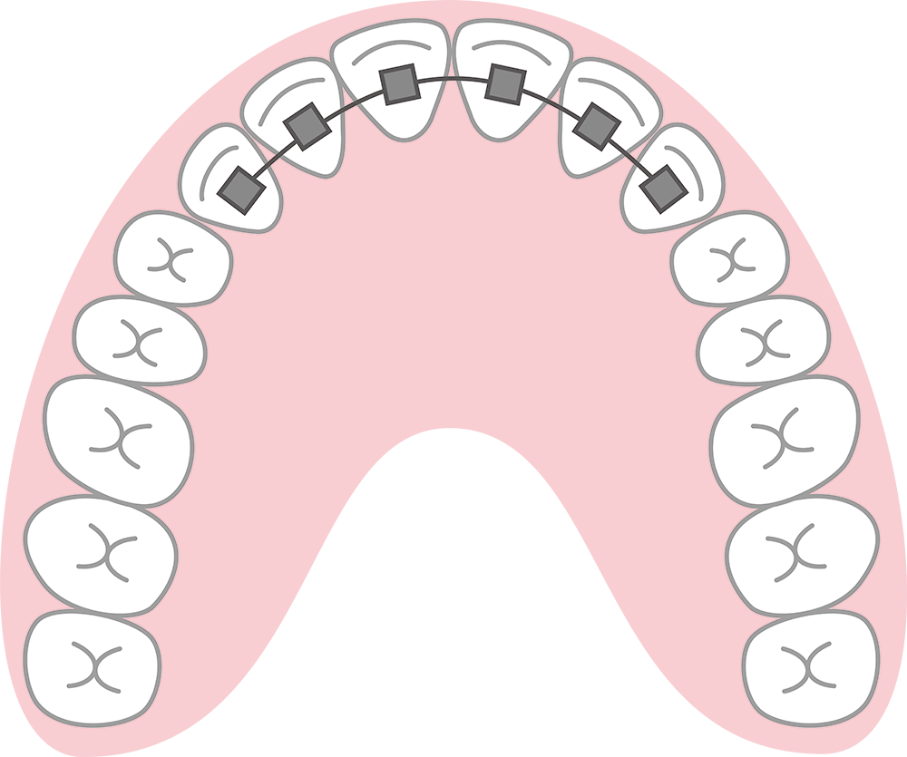 image:裏側矯正の治療期間について。出っ歯や過蓋咬合は期間が長い？