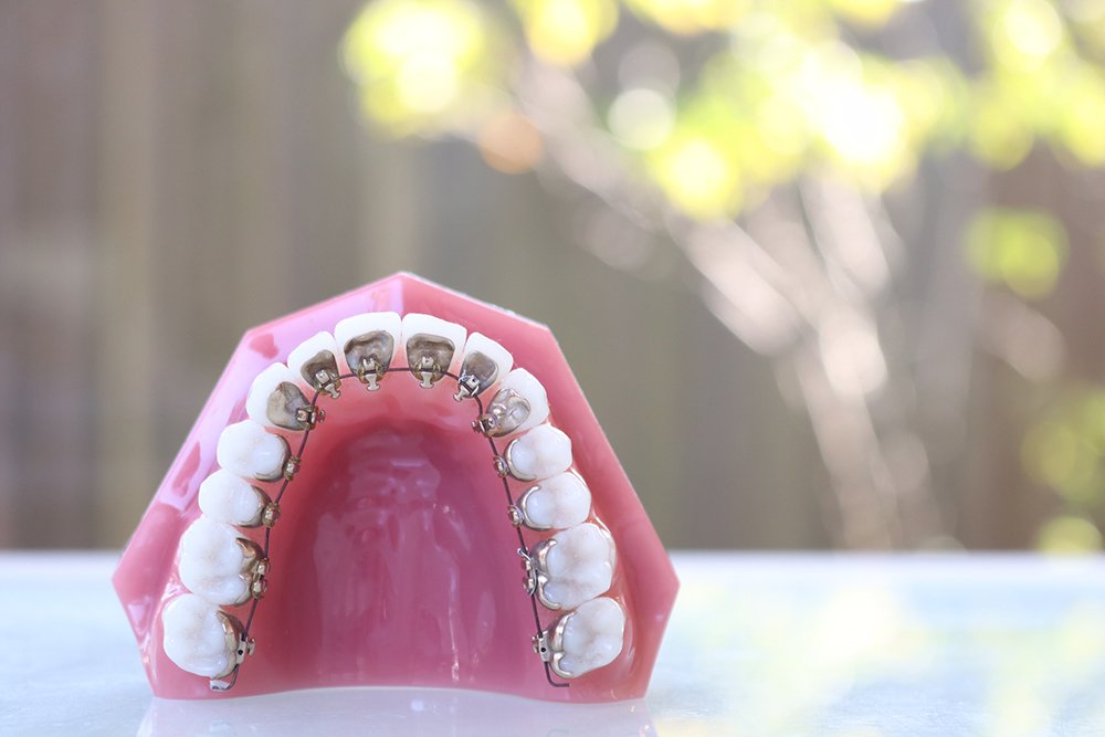 image:上の歯だけ目立たず矯正できるハーフリンガル矯正とは